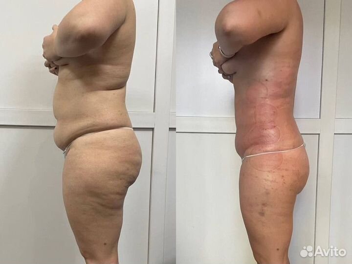 Коррекция фигуры, работа с жировыми ловушками