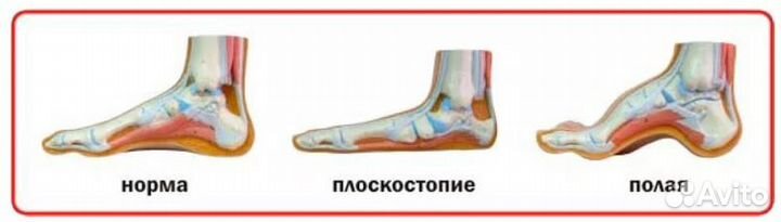 Индивидуальные ортопедические стельки изготовление