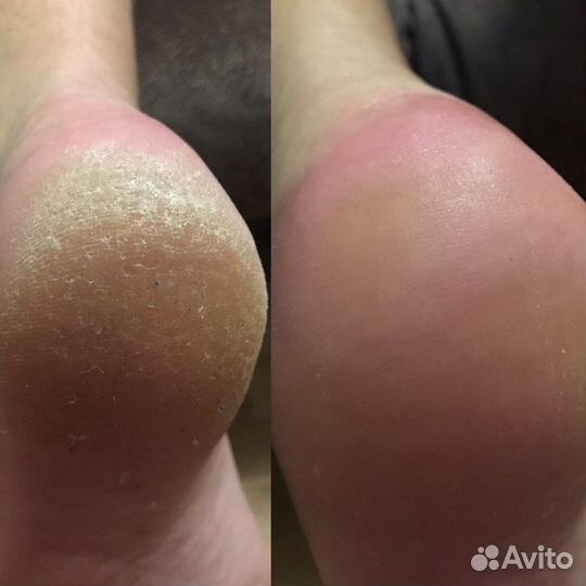 Смарт педикюр