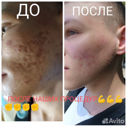 Аппаратная косметология холодная плазма