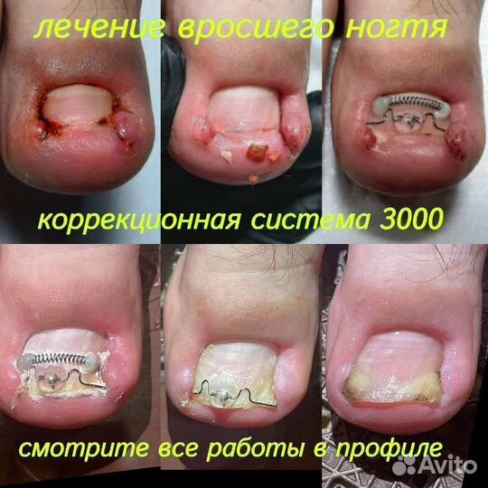 Вросший ноготь медицинский педикюр