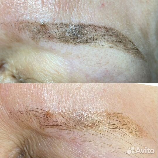 Удаление татуажа перманента ремувером