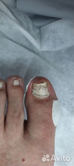 Вросший ноготь