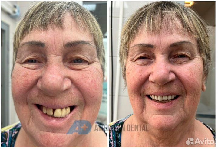 Постоянный протез + 4 импланта (ALL on 4)