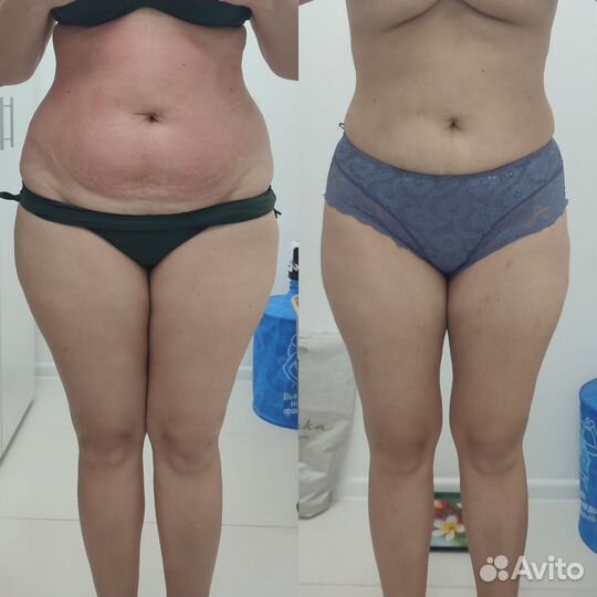 Похудение, Массаж, Аппаратная коррекция фигуры