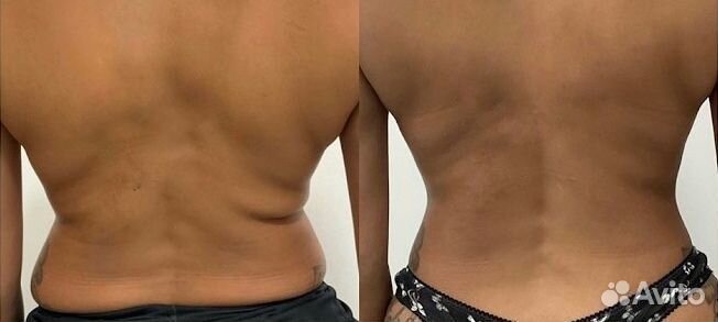 Лимфодренажный массаж