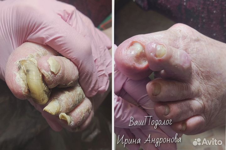 Подолог.Педикюр,вросший ноготь,трещины,мозоли