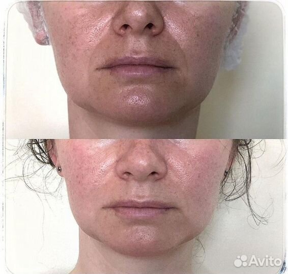 Массаж лица+ швз