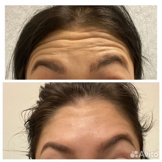 Ботокс, коктейль монако