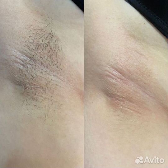 Шугаринг депиляция модель
