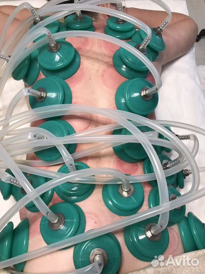 Аппаратный вакуумный массаж