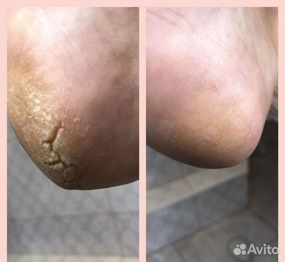 Подолог. Медицинский,Smart педикюр.Сланцы Гдов