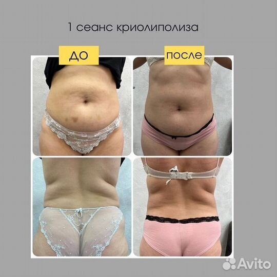 Криолиполиз + миостимуляция