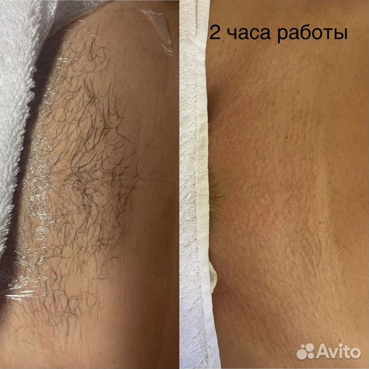 Электроэпиляция