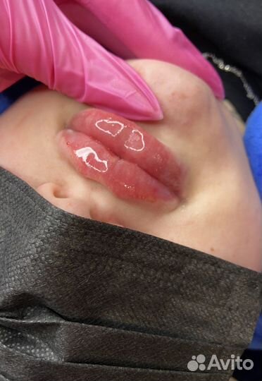 Модель на увеличение губ