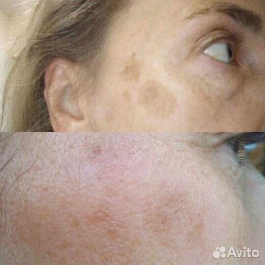 Удаление пигментных пятен, веснушек