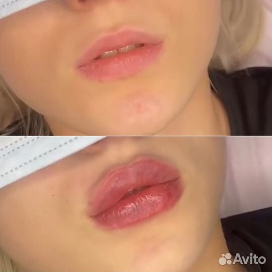 Увеличение губ