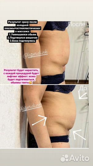 Лазерная эпиляци, холодная плазма, массаж