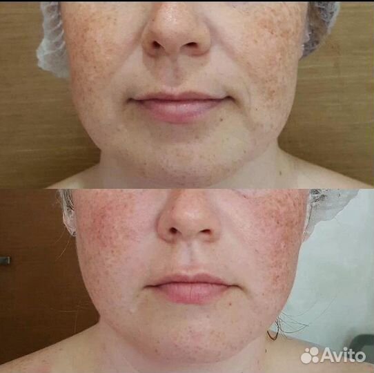 Массаж лица+ швз