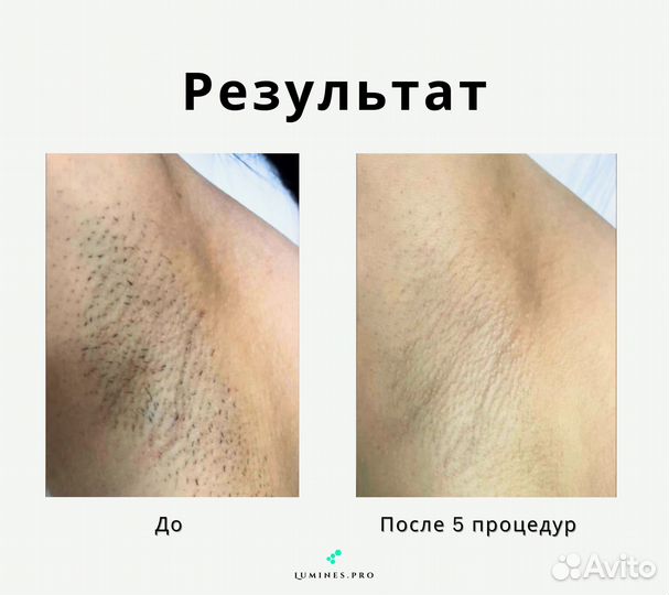 Аппарат для эпиляции Лю'Минес Макс Ван 1200