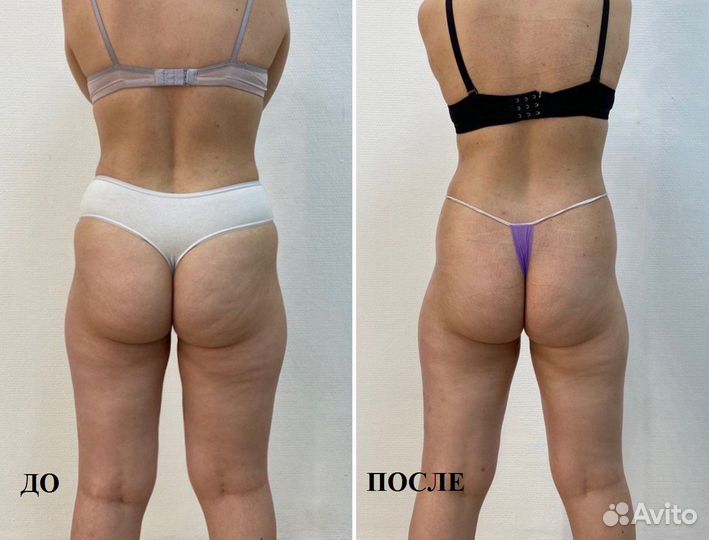 LPG массаж, коррекция фигуры