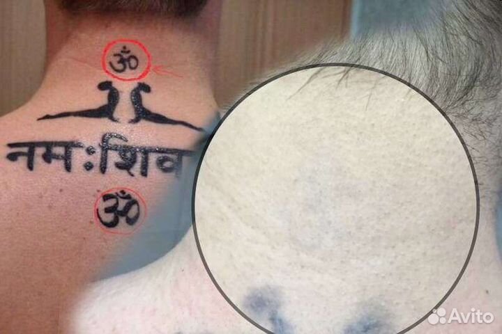 Удаление тату