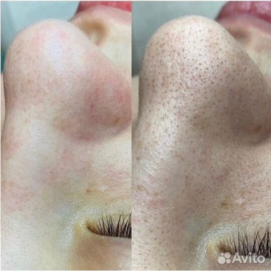 Косметолог Чистка лица