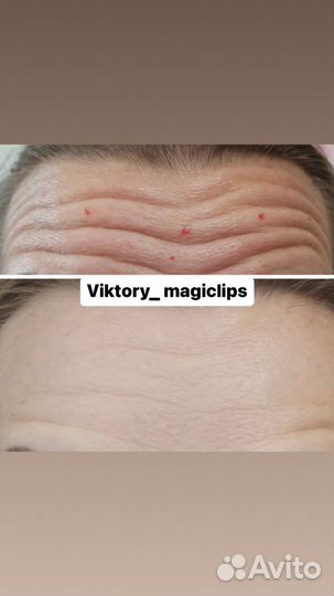 Ботокс для лица