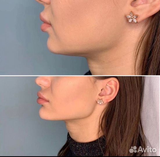 Антицилюлитный массаж в солнечном