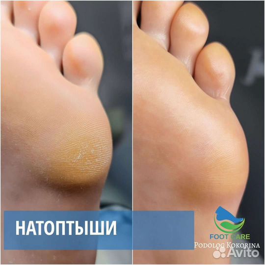 Подолог. Вросший ноготь / медицинский педикюр