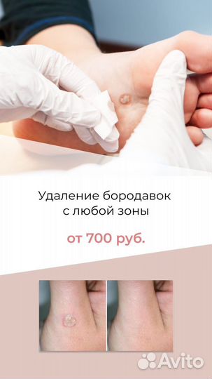 Удаление бородавок