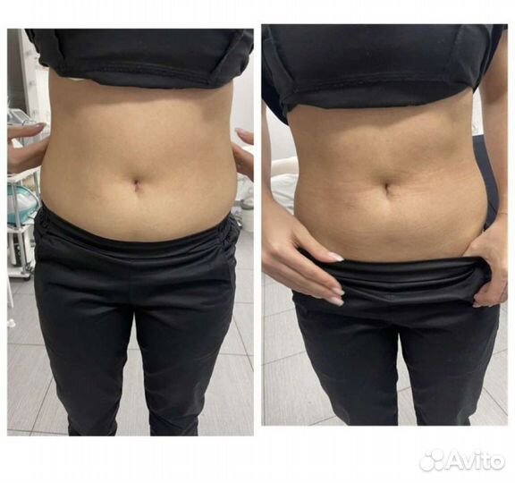 Похудение, жиросжигание с процедурой EMS