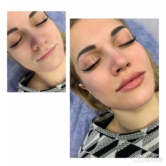 Увеличение губ/кп лица/ботокс обучение