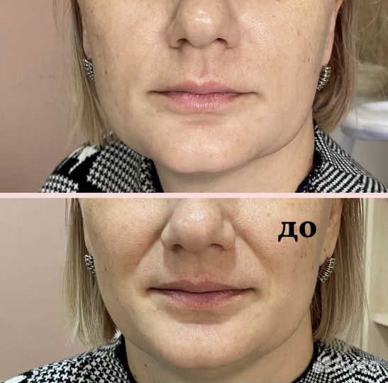 Смас лифтинг