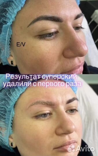 Удаление татуажа,тату, пигментации, шрамов на лица