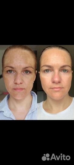 Flaxlift
