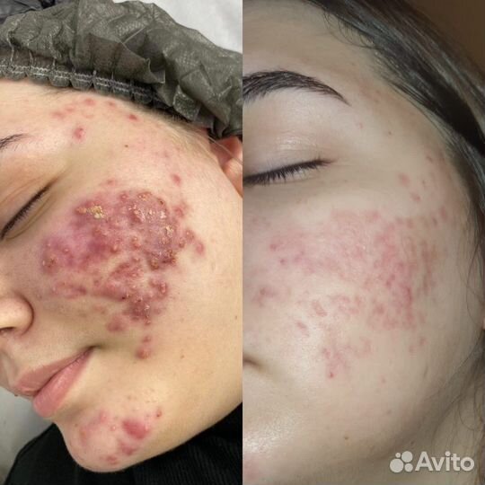 Обучение акне / постакне / коррекция рубцов