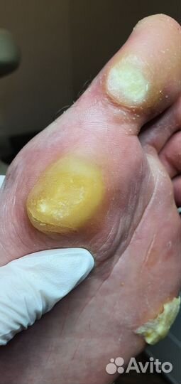 Аппаратный педикюр