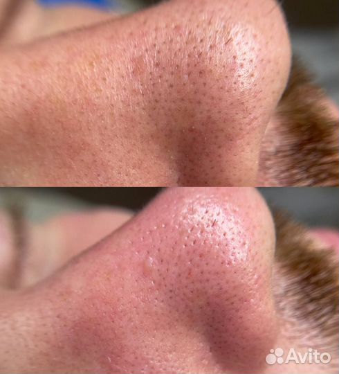 Косметолог, чистка лица, омоложение