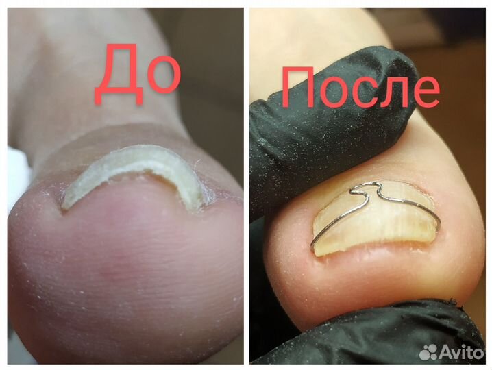 Коррекция ногтевой пластины (вросший ноготь)