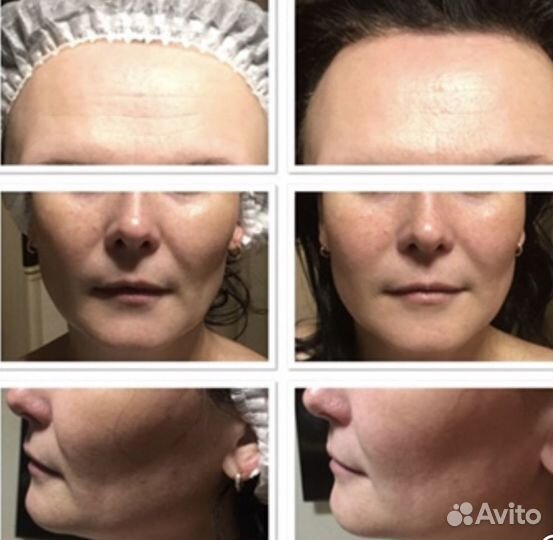 Массаж лица