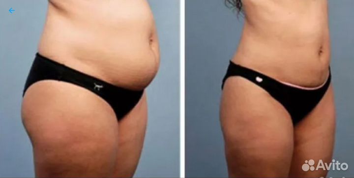 Стройное тело, упругость кожи, лифтинг на индиба