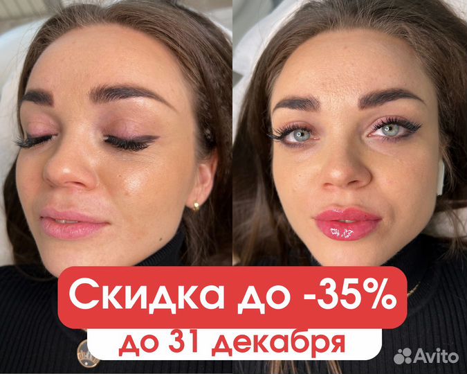 Увеличение губ, ботокс, нити, био, мезо