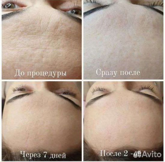 Обучение/курсы косметолог Пилинг лица FlaxNewSkin