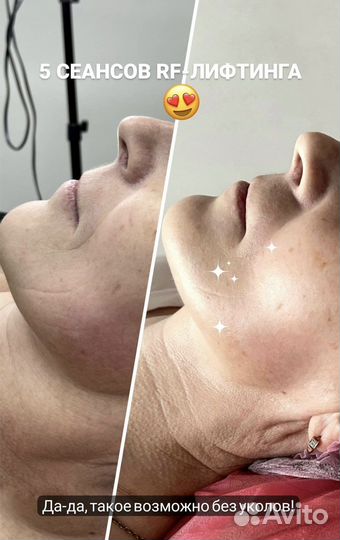 Омоложение лица рф-лифтинг