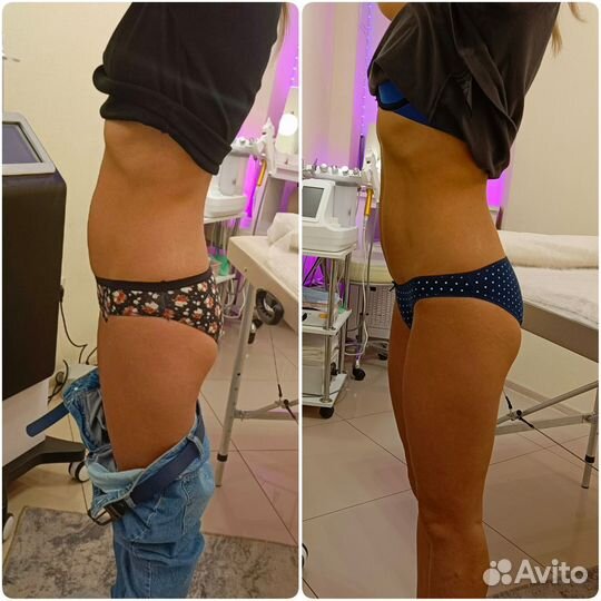 Похудение, антицеллюлитный массаж