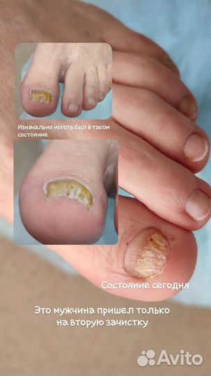 Педикюр подолог