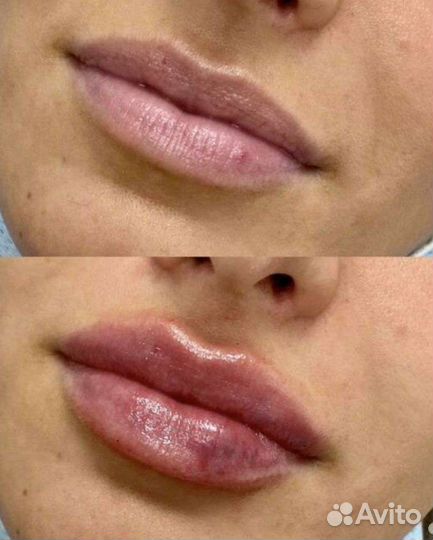 Контурная пластика