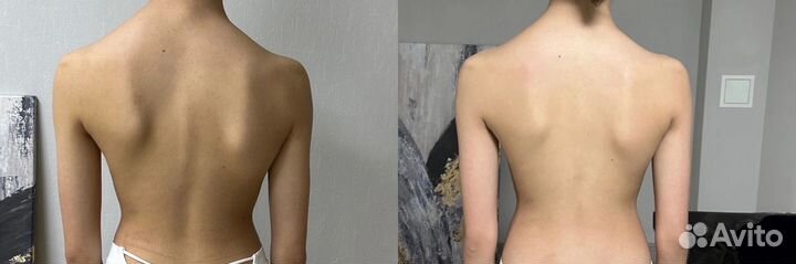 Остеопатия