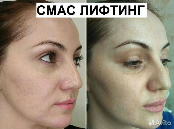 Лифтинг эффект